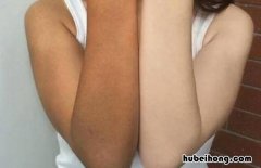 夏季晒黑怎么办 夏季晒黑怎么办小妙招