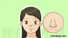 黑头怎么去简单痤康王 黑头怎么去 用痤康王