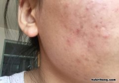 脸上痘印痘坑图片 脸上很多痘坑痘印怎么办