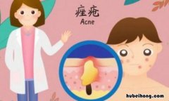痤疮和粉刺一样吗图片 痤疮跟粉刺有什么区别