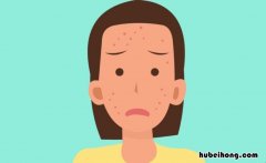 粉刺痤疮的图片 粉刺痤疮脸图片