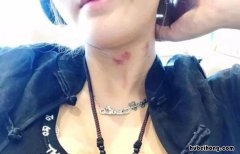 脸上有草莓印怎么消除小妙招 脸上有草莓印怎么快速消除
