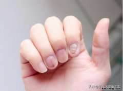 得了灰指甲怎样治疗 灰指甲怎么能治好?