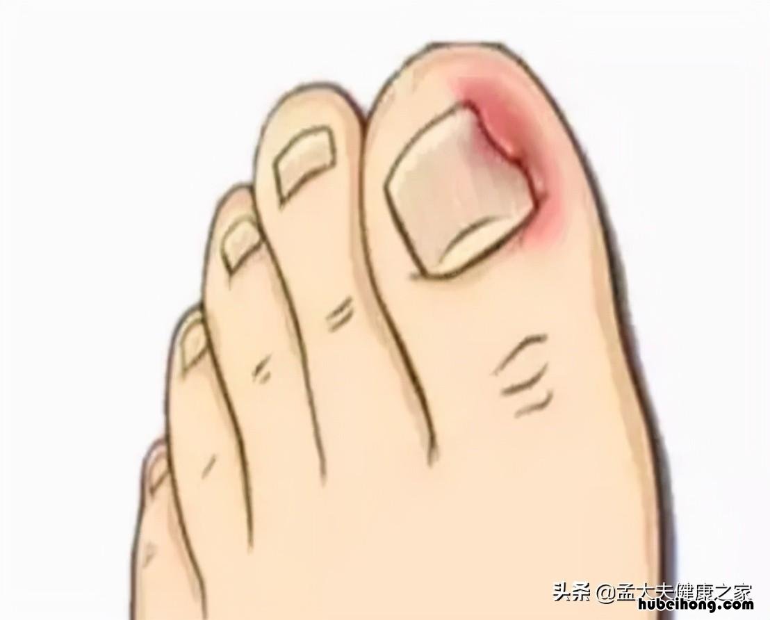 得了灰指甲怎样治疗 灰指甲怎么能治好?