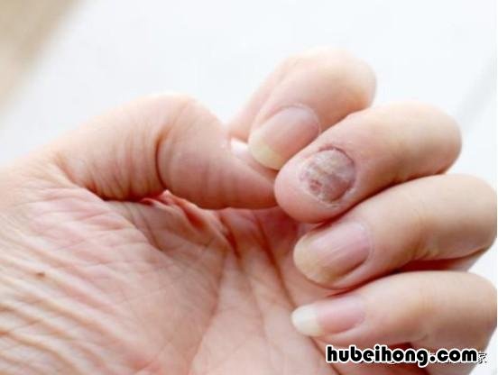 得了灰指甲怎样治疗 灰指甲怎么能治好?