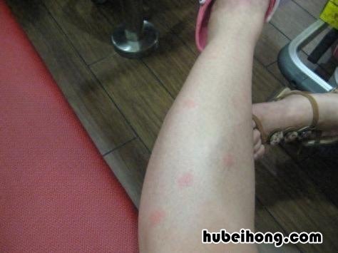 室外怎么灭蚊子最有效 室外怎么灭蚊虫