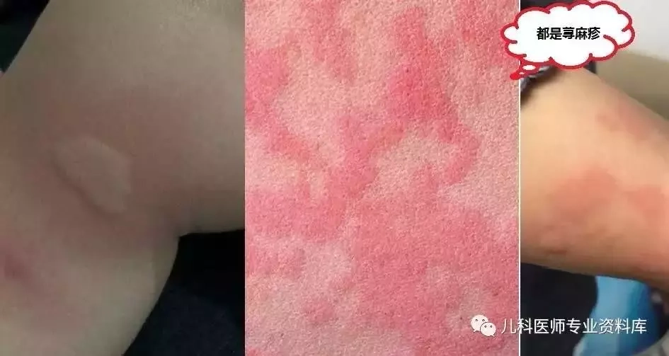 螨虫除去最快方法 螨虫清除方法