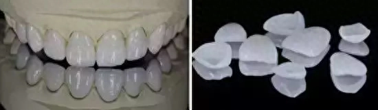 牙齿美白有几种可靠的方法? 牙齿美白效果怎么样