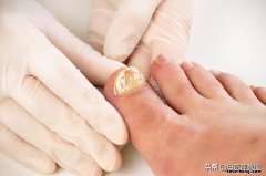 什么原因会引起灰指甲 是什么导致灰指甲